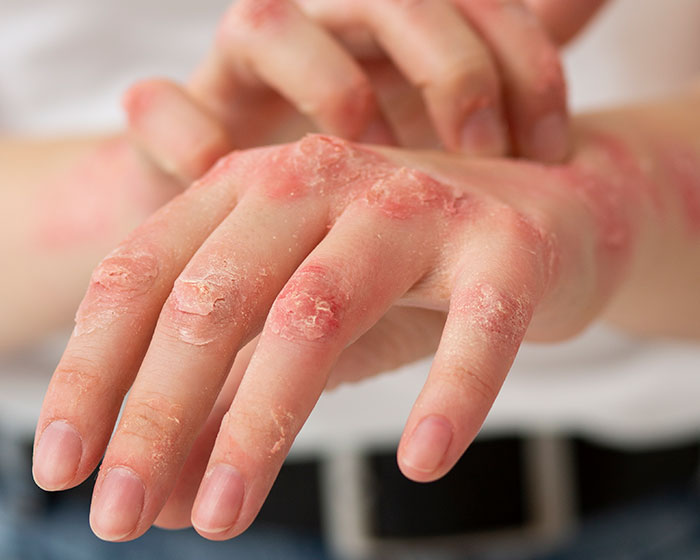 Hands affected by a severe skin problem with red, scaly patches, indicating a potential red flag for health. Hands affected by a severe skin problem with red, scaly patches, indicating a potential red flag for health.