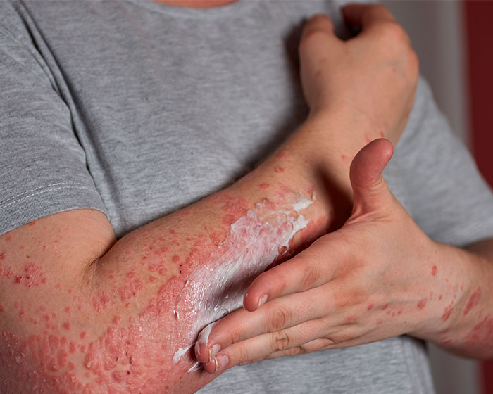 Person applying cream to a red rash on their arm, a major red flag on skin for heart problems. Person applying cream to a red rash on their arm, a major red flag on skin for heart problems.
