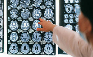Experts Warn Of Commonly Dismissed Dementia Symptoms That Can Surface 15 Years Before Doctors Catch It