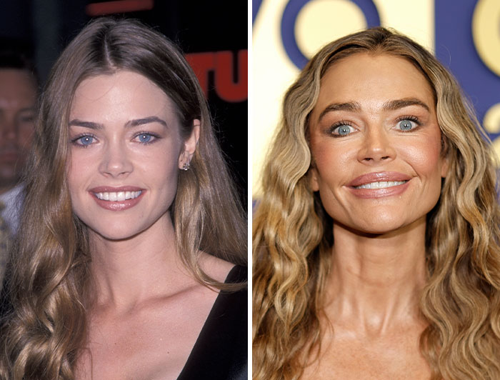 Denise Richards pre-plastic surgery photo on the left, showing her current appearance on the right, as a celebrity example.