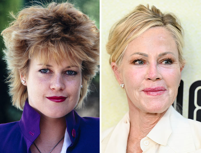 Melanie Griffith pre-plastic surgery and post-plastic surgery comparison photos of celebrities.