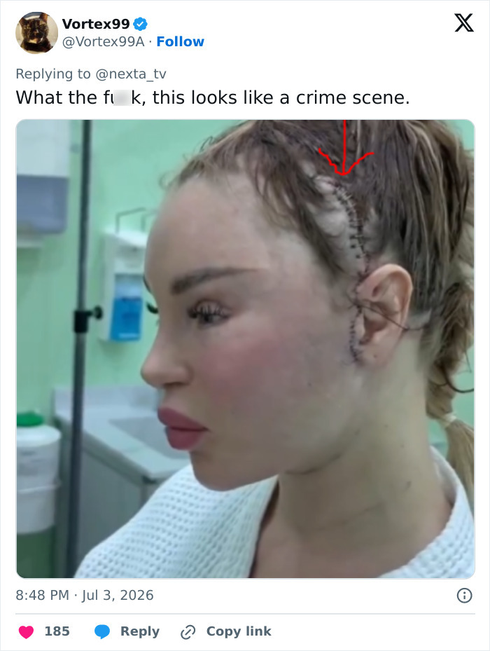 Woman’s Post-Plastic Surgery Photos Divide The Internet As She And Her Surgeon Celebrate The Results