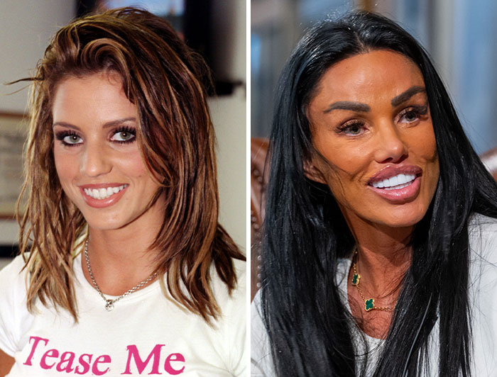 Katie Price pre-plastic surgery and post-plastic surgery comparison photos of celebrities.