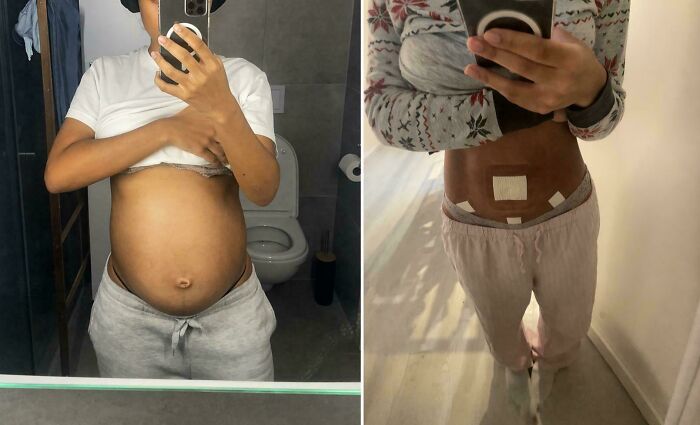 A before-and-after photo shows a person's pregnant belly next to their stomach post-surgery, highlighting body changes.