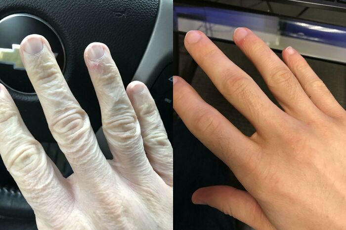Before-and-after photo of a hand, illustrating how much things can change, focusing on skin texture differences.