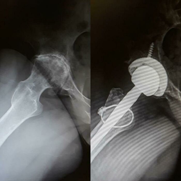 Before-and-after photos showing an X-ray of a damaged hip next to a repaired hip with a metal implant.