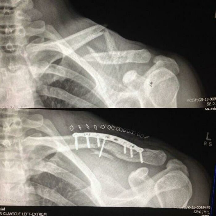 Before-and-after X-rays of a collarbone, showing the bone before and after surgical repair with a metal plate, depicting change.