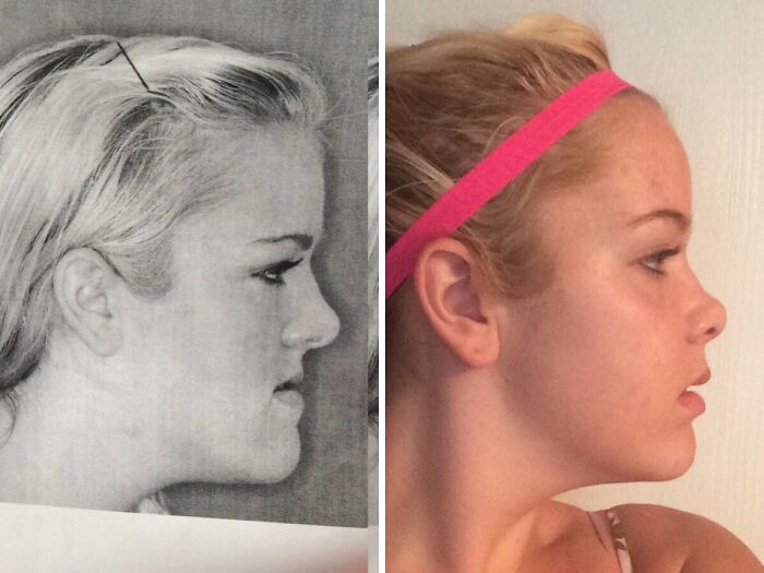 Before-and-after photo of a woman's profile, demonstrating how much things can change in facial structure.