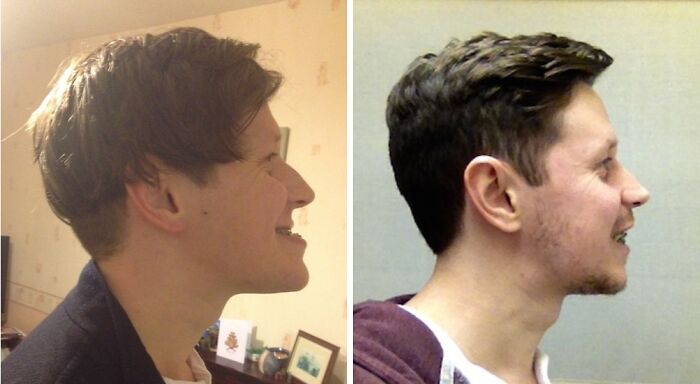 A before-and-after photo shows a person's profile, first with a receding chin, then with a more defined jawline.