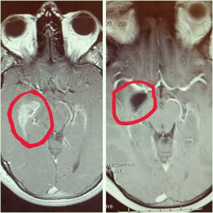 Before and after photos of brain MRI scans, showing a visible change in a highlighted area, demonstrating how things change.