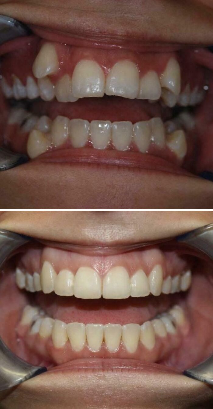 A before-and-after photo shows a person's teeth, first misaligned, then straight and perfectly aligned after orthodontic treatment.