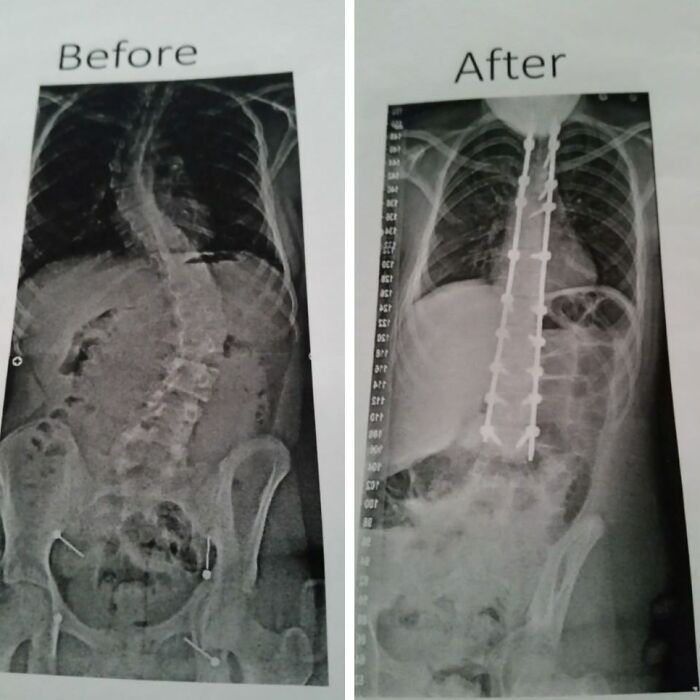 Before-and-after X-rays illustrating a significant change in spinal alignment, showing how things can change.
