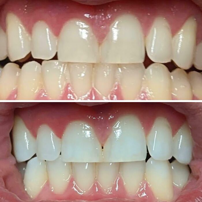 Before-and-after comparison of teeth, illustrating how much things can change after cleaning.