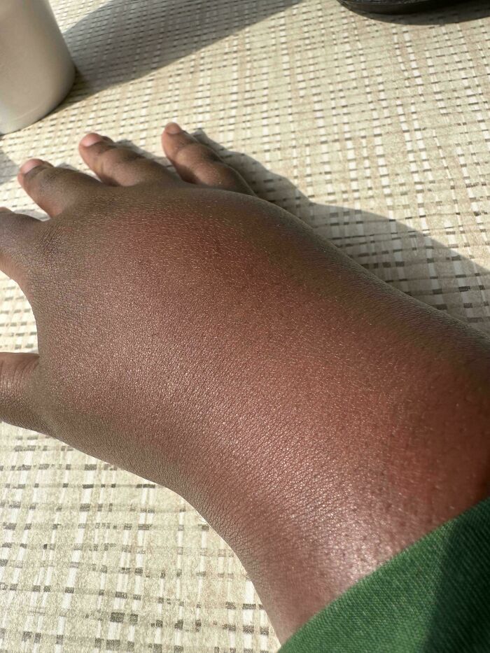 A human body part, a hand, appearing swollen and red, highlighting the amazing and strange human body.