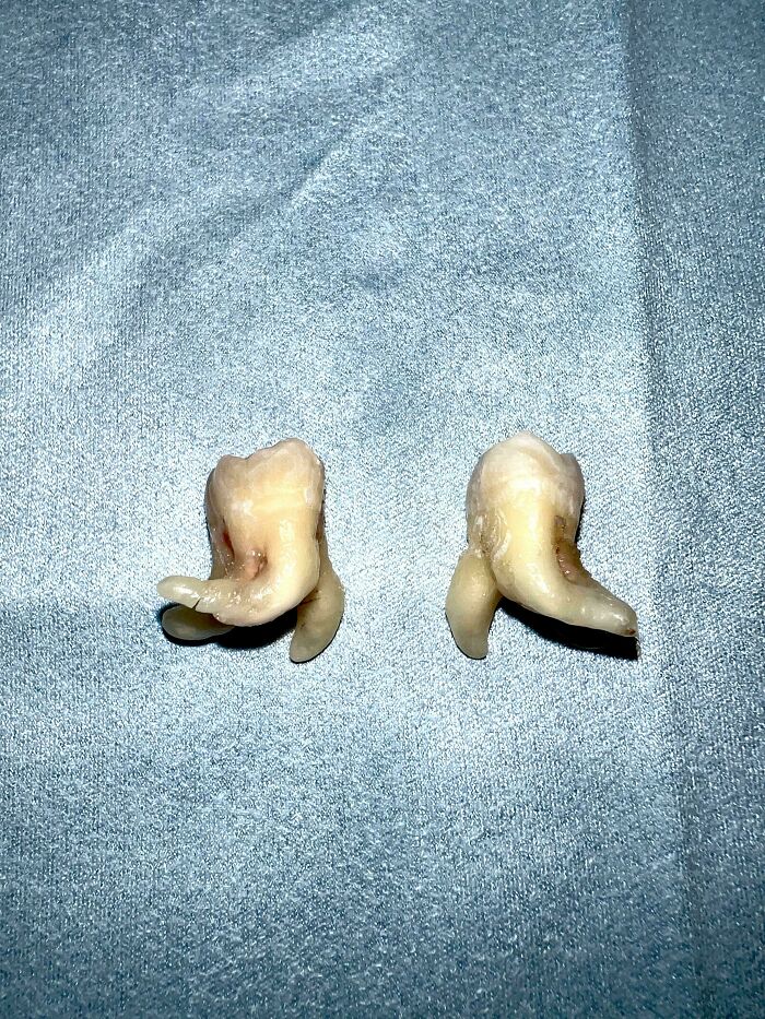 Two extracted teeth with unusual roots, examples of the strange human body.