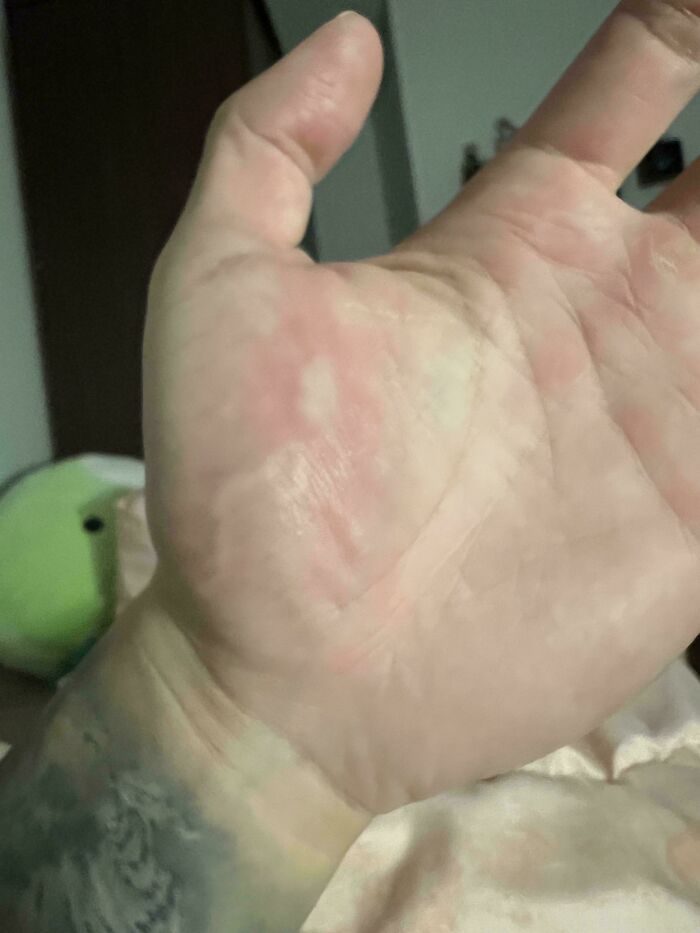 Red, irritated palm of a hand, highlighting the amazing human body.