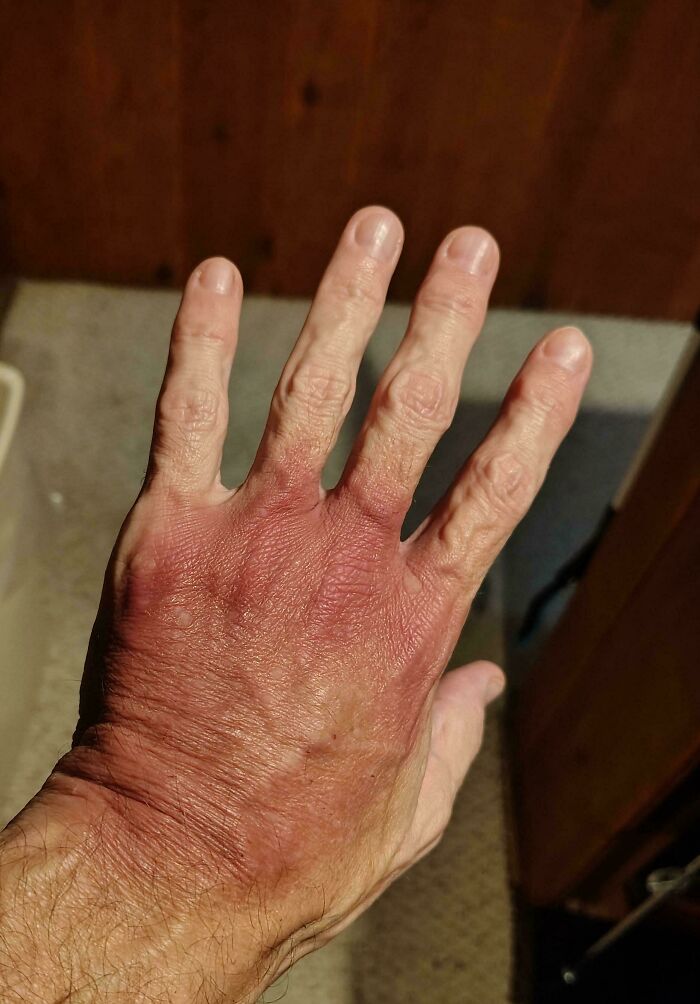 A hand with a severe red rash, highlighting the strange and amazing human body's reactions.