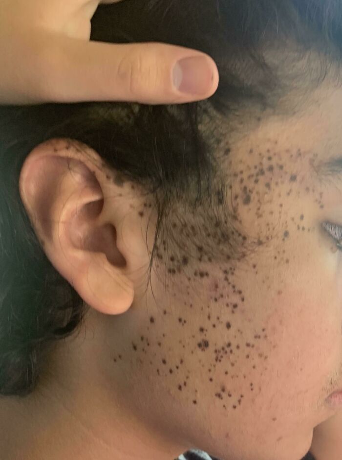 Person with many dark spots on their face and ear, displaying the strange human body.