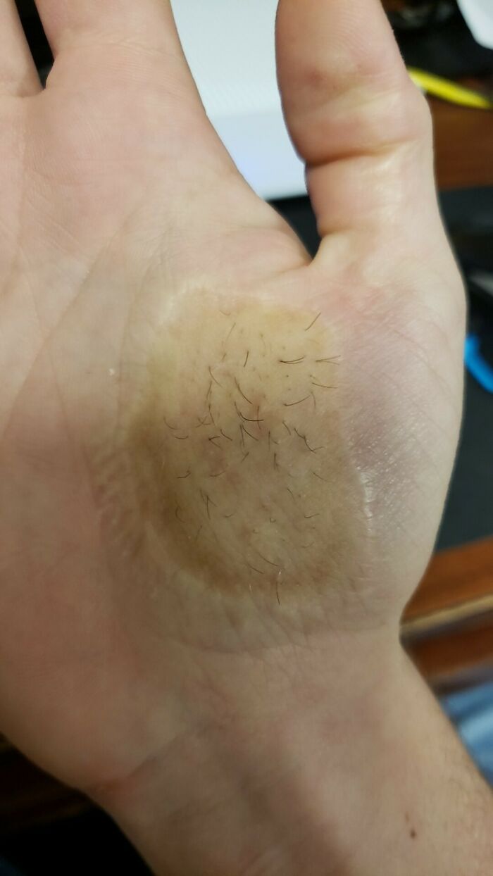 A close-up image of a strange human body phenomenon: a circular patch of hairy skin on the palm of a hand.