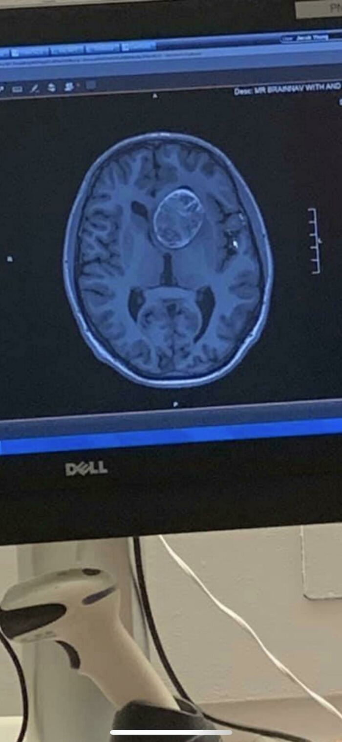 An MRI scan of the human body showing a large, circular mass in the brain, a strange and amazing medical case.