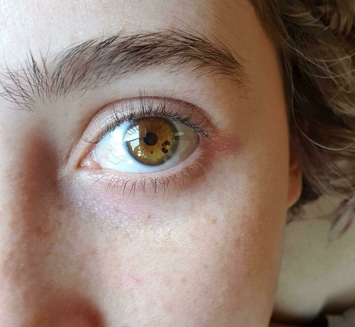 A detailed close-up of a human body eye with a unique brown iris featuring several distinct darker spots, showcasing amazing biology.