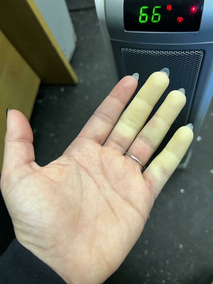 A hand with fingers turned pale yellow, illustrating a strange condition affecting the human body.