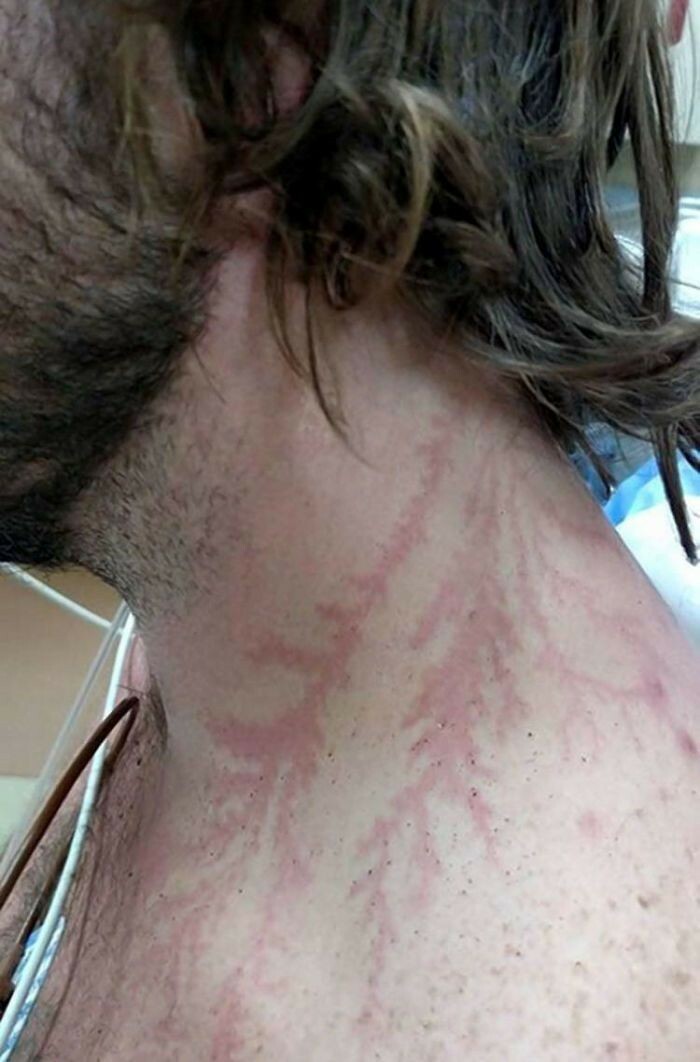 A man's neck and chest showing red, branch-like patterns from a lightning strike, a strange human body phenomenon.