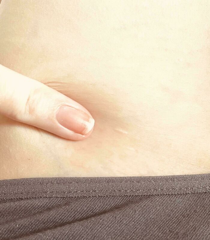 A finger pointing to a small, white scar on the skin, illustrating the strange and amazing human body.