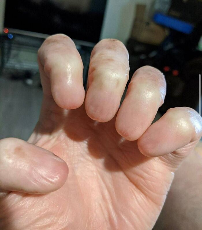 Close-up of a hand with swollen, strange fingers, highlighting the unique human body.