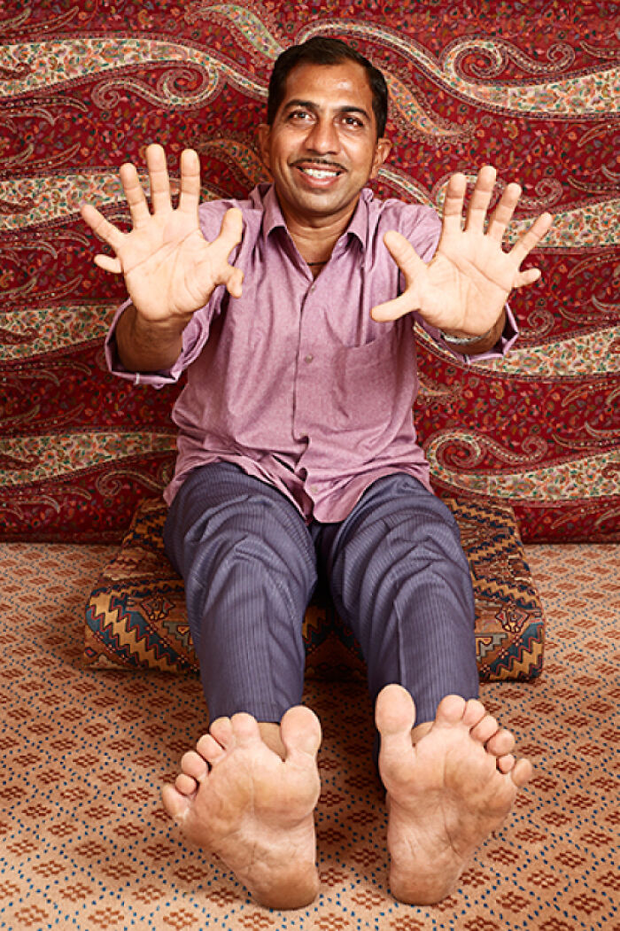 A man with 10 fingers and 10 toes, showcasing the amazing human body.