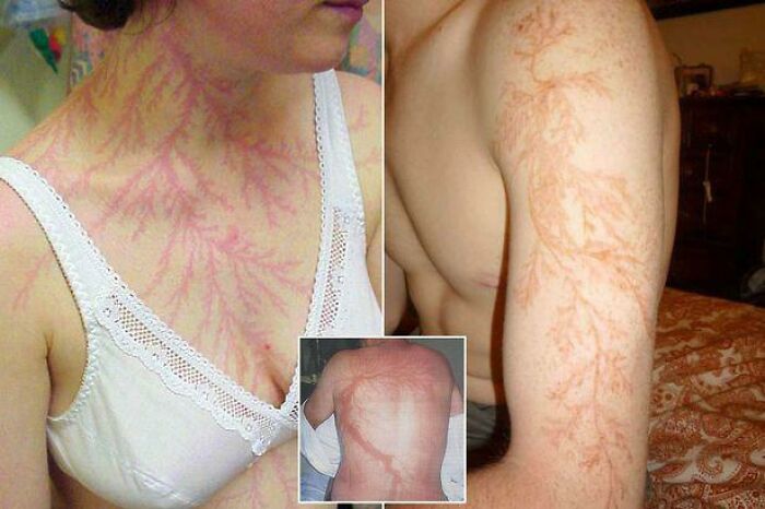 Images showing Lichtenberg figures, fern-like patterns, on a person's skin, a strange effect on the human body.