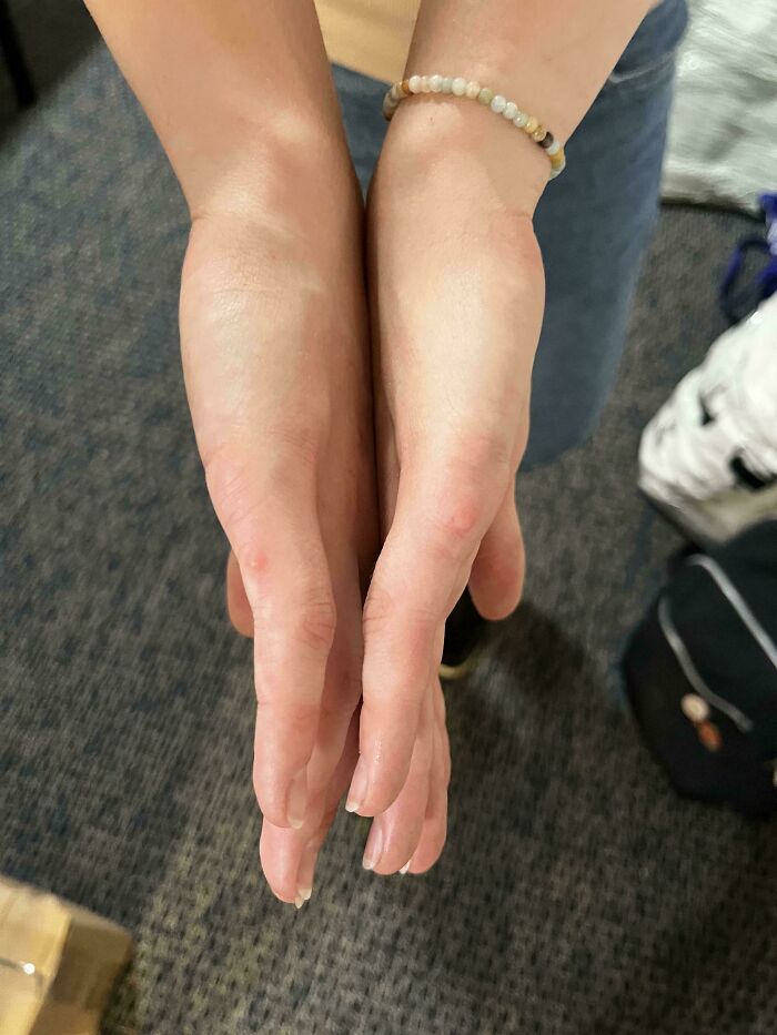 A person with hypermobile hands bent backward at extreme angles, highlighting the amazing human body.