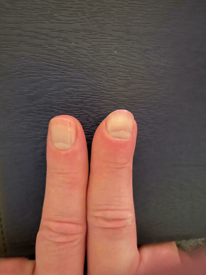 Close-up of fingers with flat, wide nails, highlighting the strange and amazing human body.