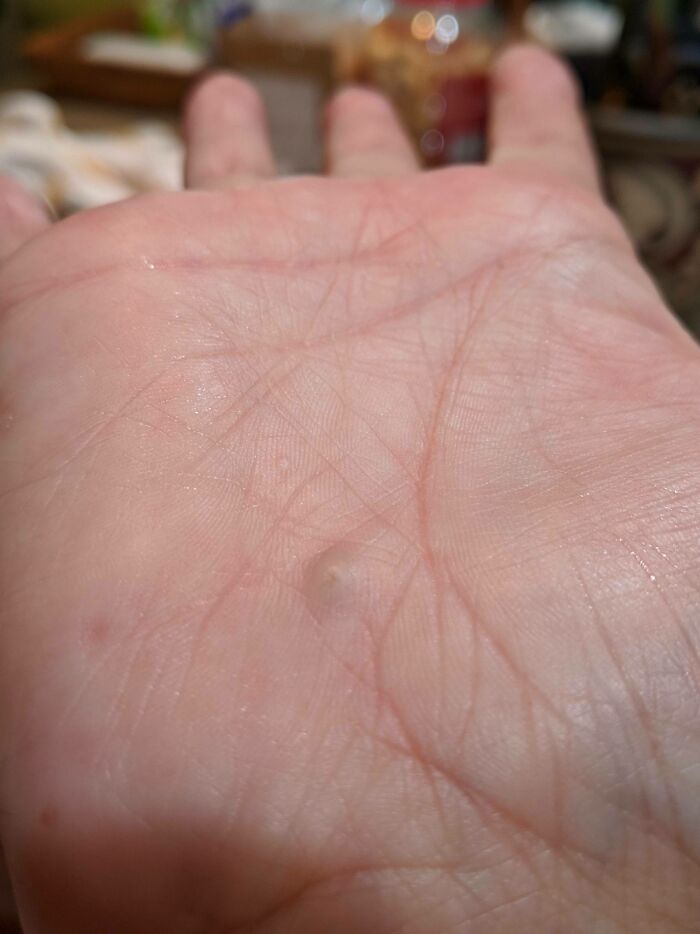 A close-up of a human palm with a small raised bump, illustrating the strange and amazing human body.