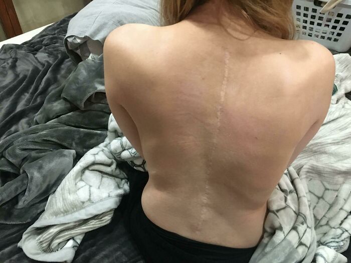A woman's back revealing a long scar down her spine, showcasing the strange human body and its resilience.
