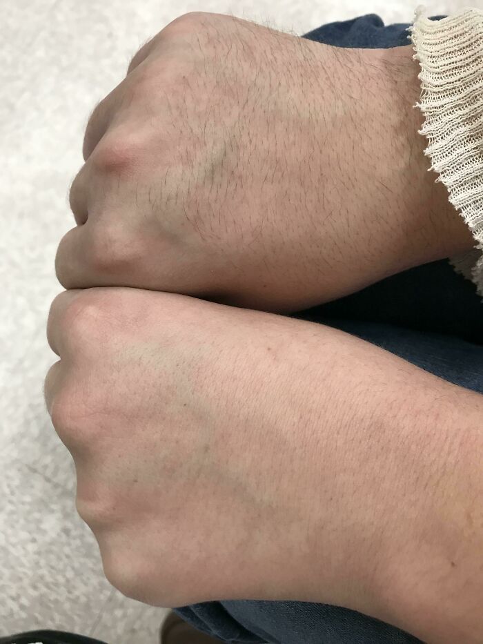 Two fists side-by-side, one with noticeably more hair than the other, demonstrating the amazing and strange human body.