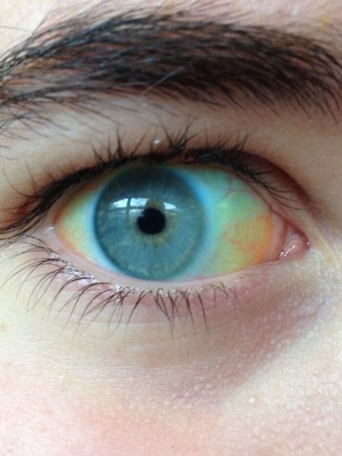 Close-up of a human body eye with a unique blue and yellow iris, highlighting the strange and amazing human body.