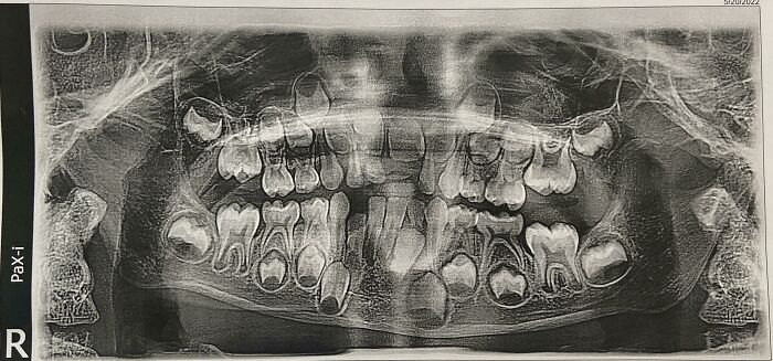 A full mouth dental X-ray of a human body, revealing numerous strange and crowded teeth, some of which are still developing.