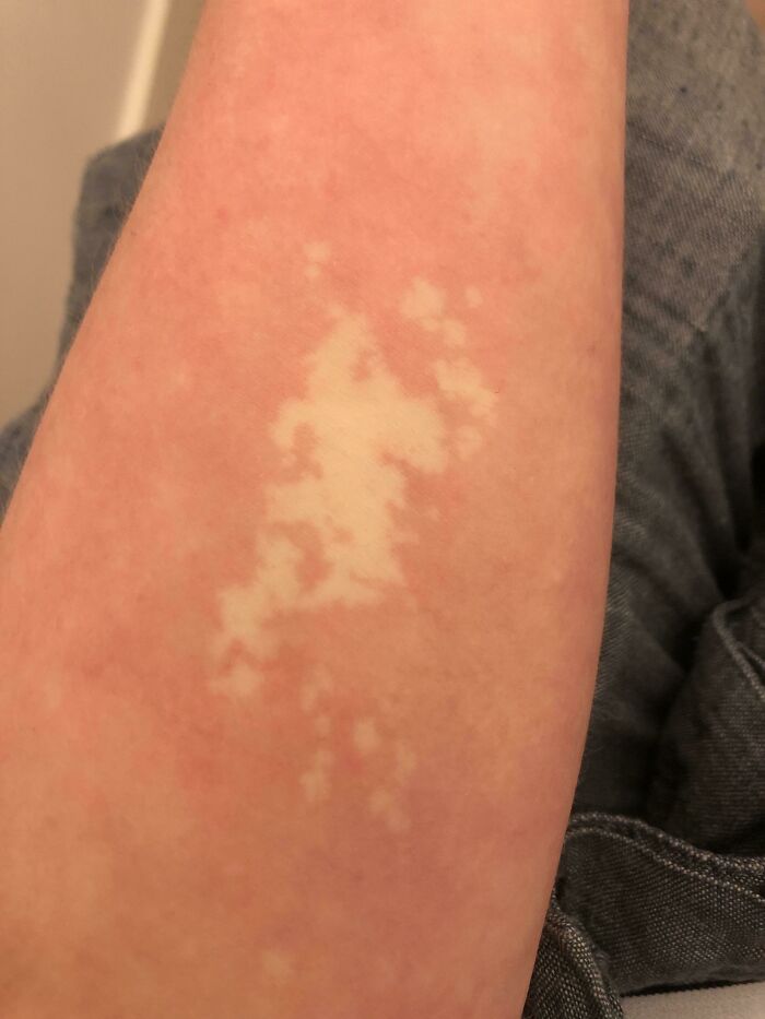 A human body arm with a distinct pale skin patch against red skin, illustrating the strange and amazing human body.