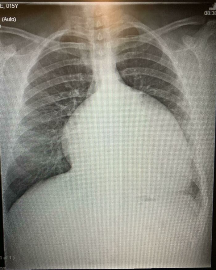 An X-ray revealing an enlarged heart, showcasing the strange and amazing human body.