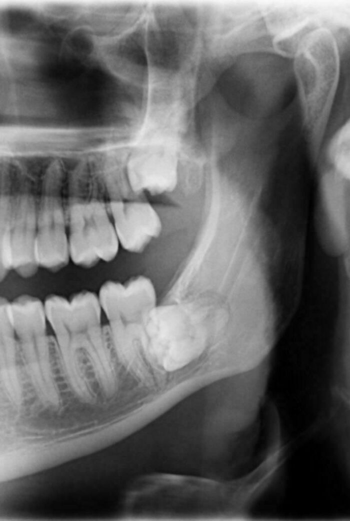 An X-ray of a human body jaw showing an impacted wisdom tooth, revealing the strange and amazing human body.