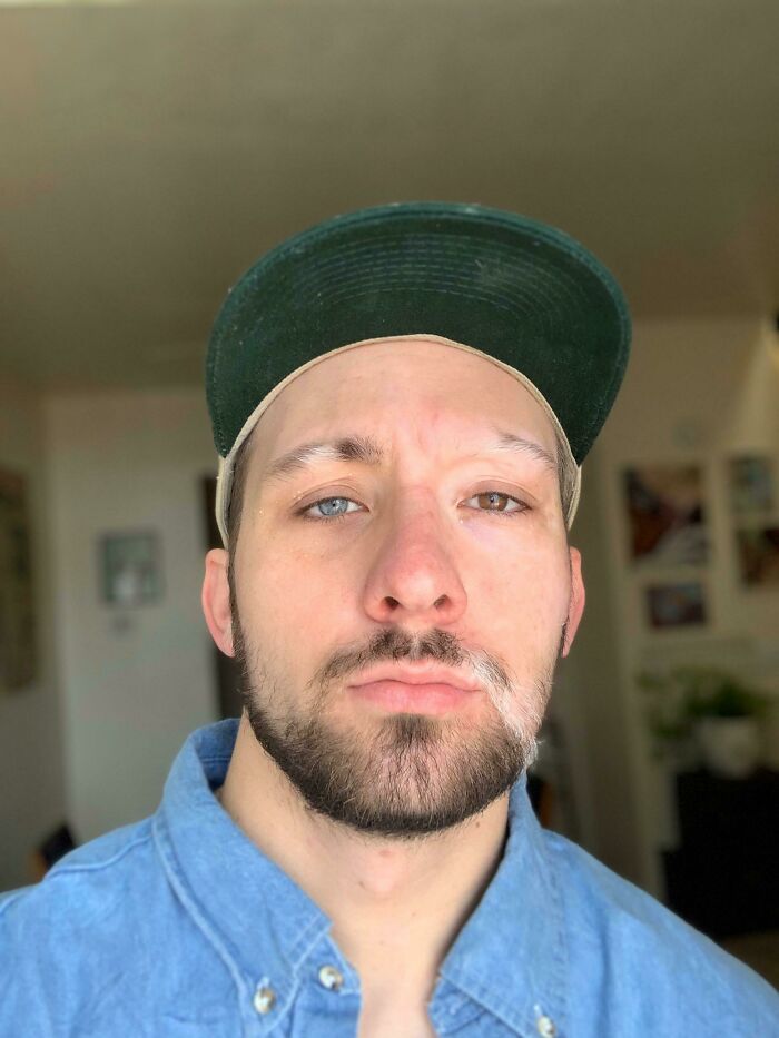 A man with heterochromia and a white streak in his beard, highlighting the strange and amazing human body.