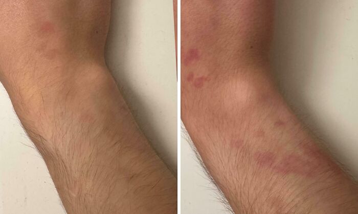 A before and after comparison showing a human arm with a rash developing, an example of the strange human body.