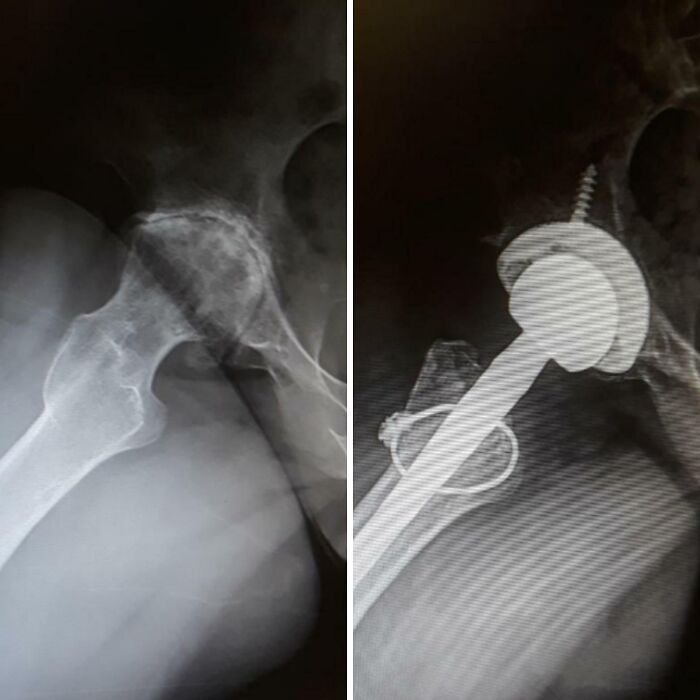 Before-and-after X-rays of a hip, one showing a fractured hip, the other a hip replacement, amazing human body.
