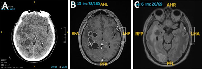 Three medical scans of a human brain (A, B, C) revealing complex structures, central to a brain cancer horror story.