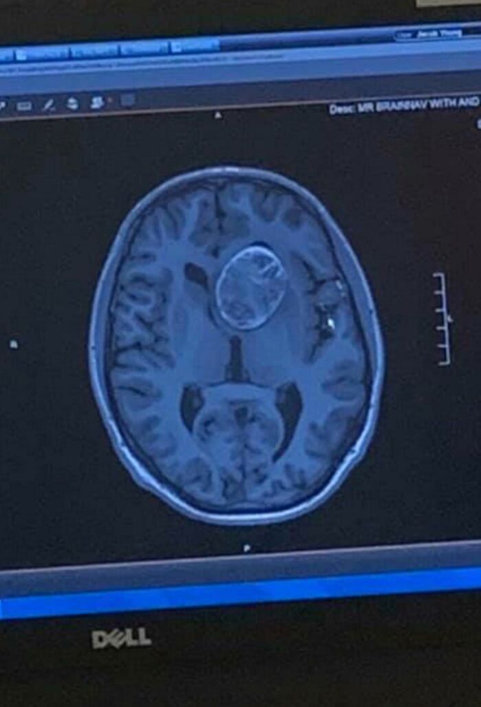 An MRI scan of the human body showing a large, circular mass in the brain, a strange and amazing medical case.