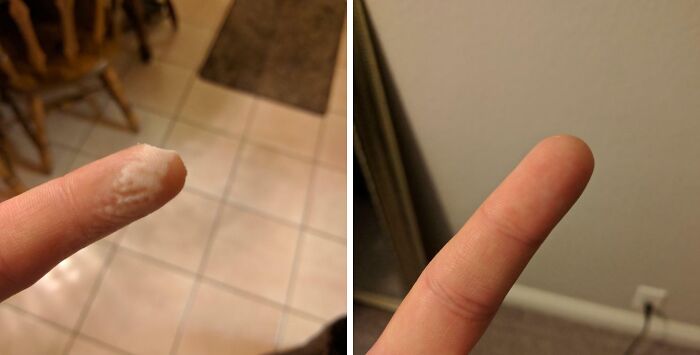 Before-and-after image of a finger showing a removed wart, proving the strange and amazing human body.