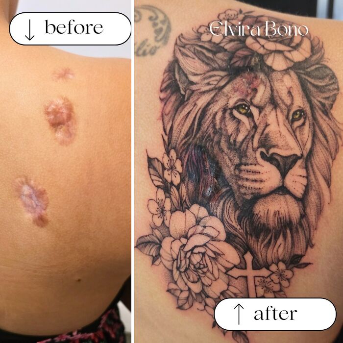 Tattoo On Keloid Scars For Acne