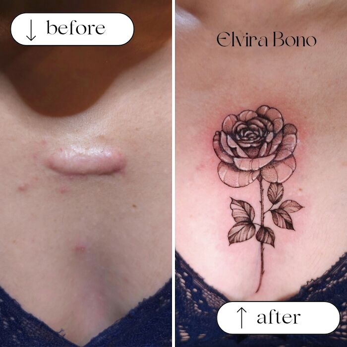 Tattoo On Keloid Scar