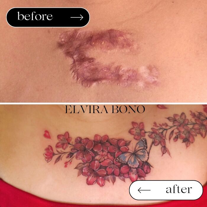 Tattoo On Keloid Scar For Acne